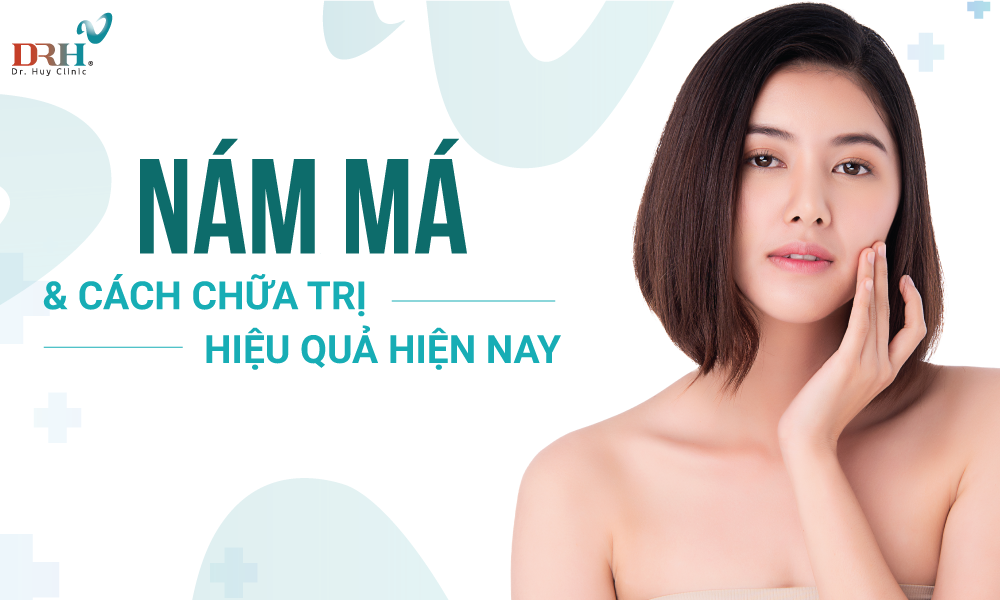 Vén màn bí ẩn về nám má và cách chữa trị hiệu quả hiện nay - DRH Clinic