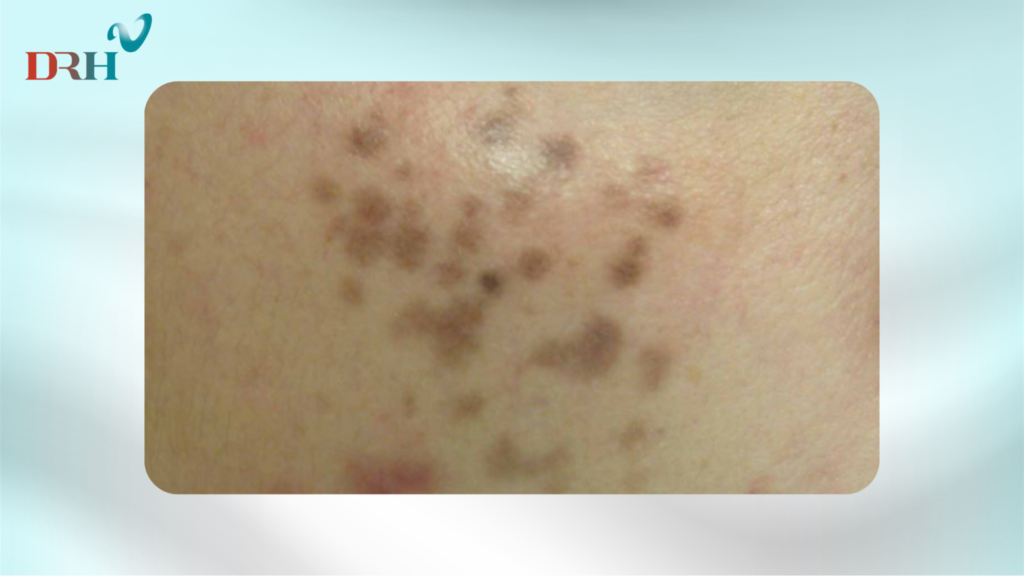 cach-tri-nam-chan-sau-tai-nha-1