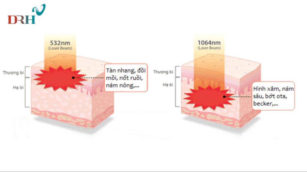cong-nghe-laser-toning-1