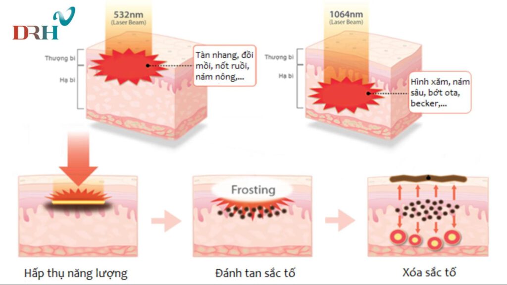 dieu-tri-nam-da-bang-tia-laser-1