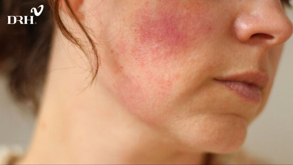 dieu-tri-nam-da-bang-tia-laser-2