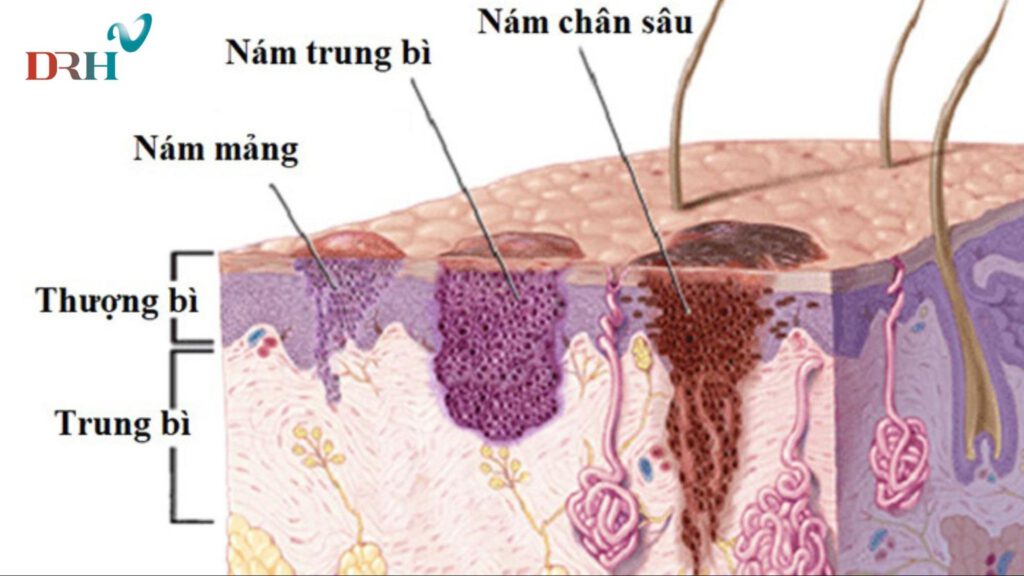 laser-tri-nam-benh-vien-da-lieu-3