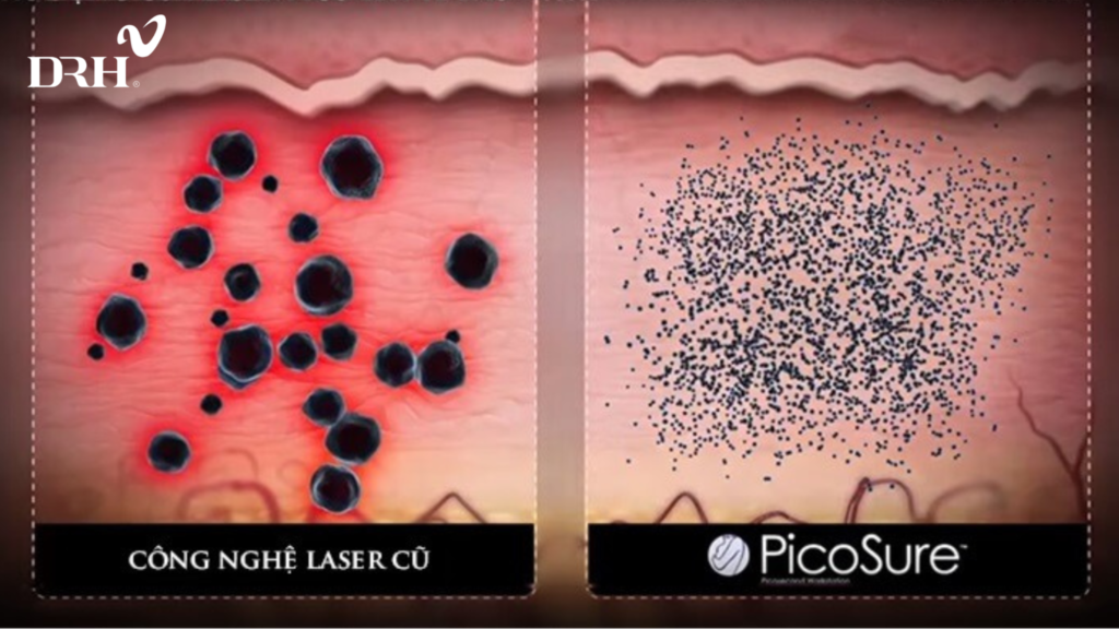 tri-nam-bang-laser-Picosure-co-tot-khong-1
