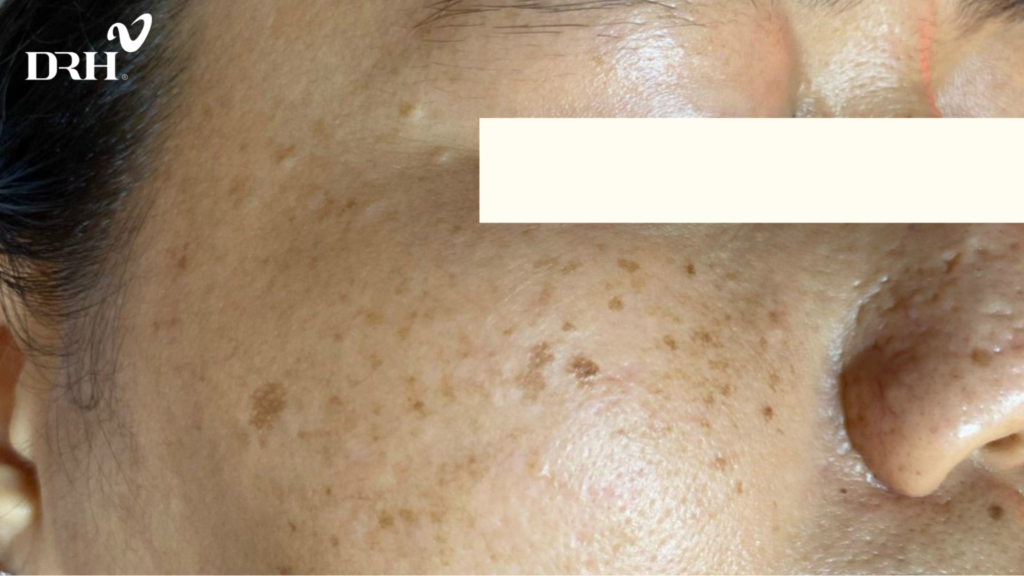 tri-nam-chan-sau-bang-laser-1