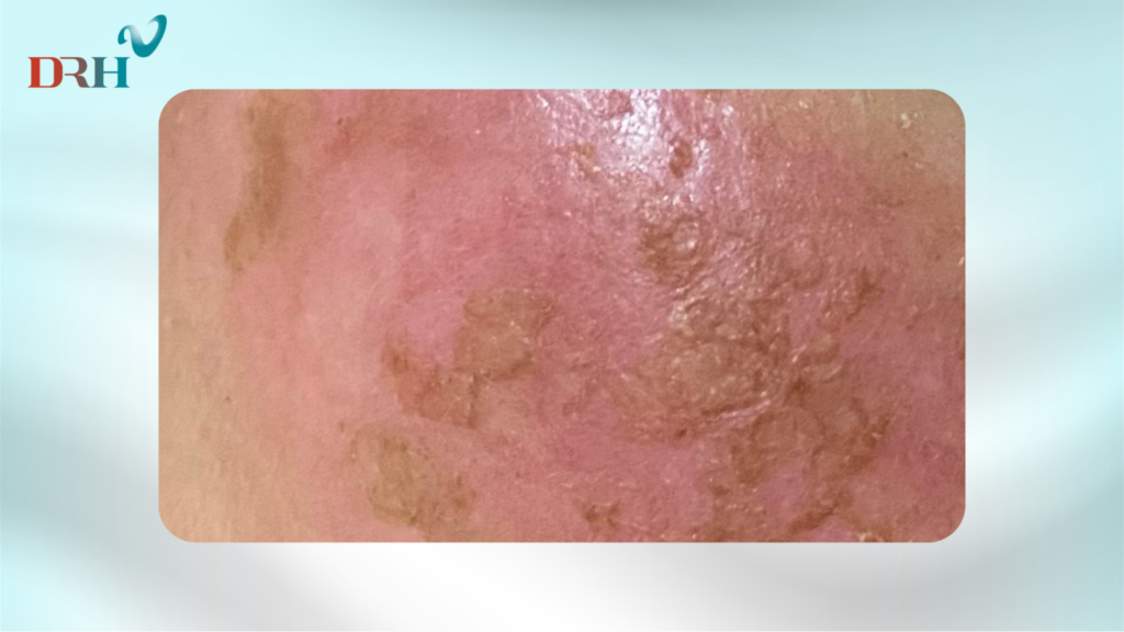 tri-nam-chan-sau-bang-laser-3