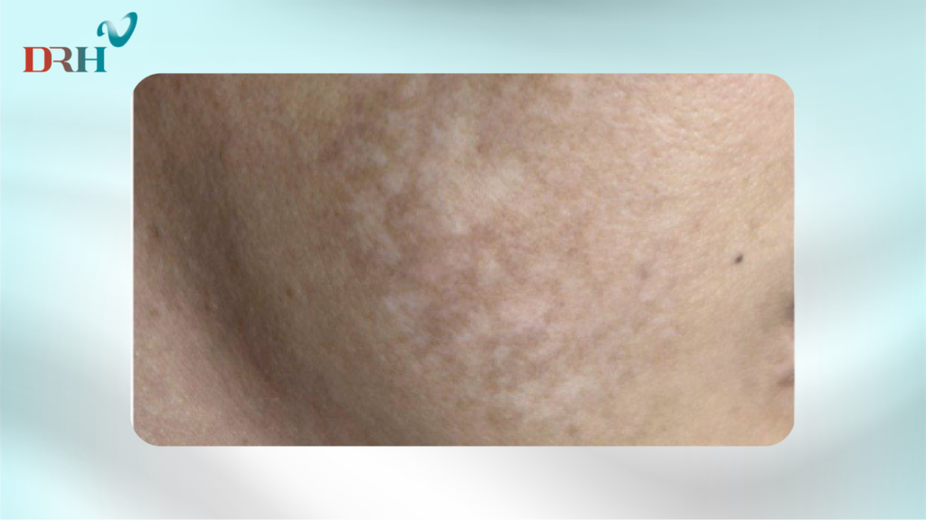 tri-nam-chan-sau-bang-laser-5