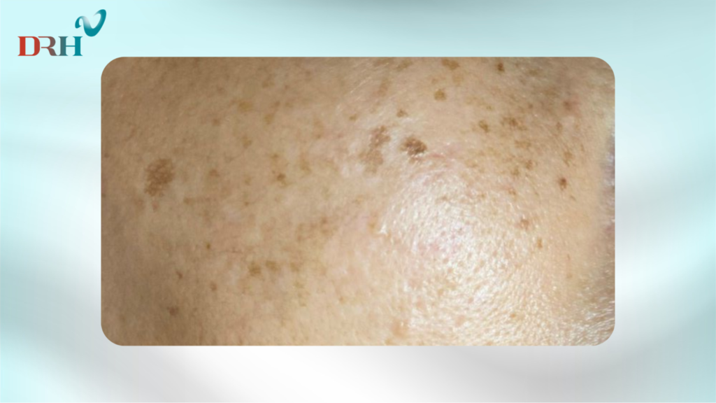 cach-tri-nam-chan-dinh-tai-nha-1