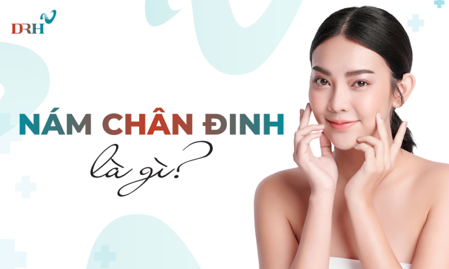 Nám chân đinh là gì? nguyên nhân và cách điều trị hiệu quả - DRH Clinic