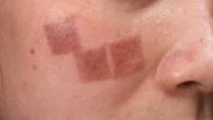 Da bị hư tổn khi trị nám chân đinh bằng laser xâm lấn giá rẻ